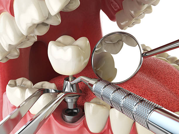 Best Emergency Root Canal Treatment in Winston Salem, NC